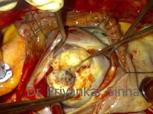 Rheumatic mitral stenosis with thick leaflets and fused subvalvar apparatus severely narrowing the orifice