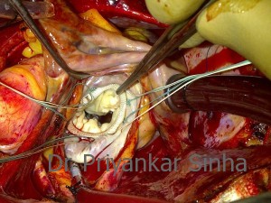 Rheumatic mitral stenosis (MS), the clean and pliable valve after repair with a rigid shaped ring