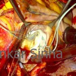 Rheumatic mitral stenosis (MS), the mitral valve beautifully competent on testing.