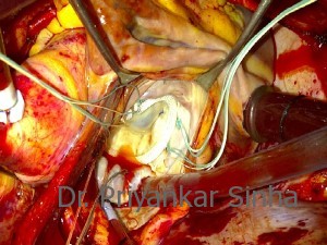Rheumatic mitral stenosis (MS), the mitral valve beautifully competent on testing.