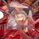 Having put the ring sutures in place, the Mitral Valve is tested after repair.